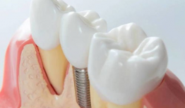 种植牙视频,从术前准备到术后护理